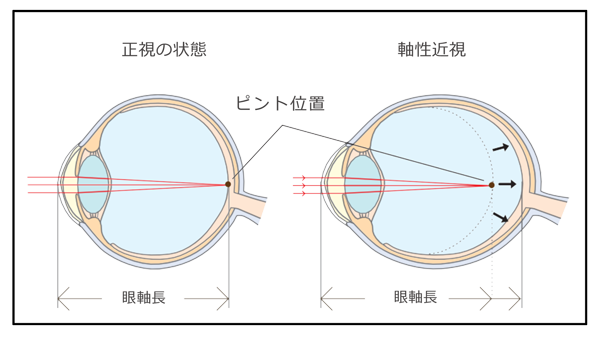 そもそも「近視」とは？