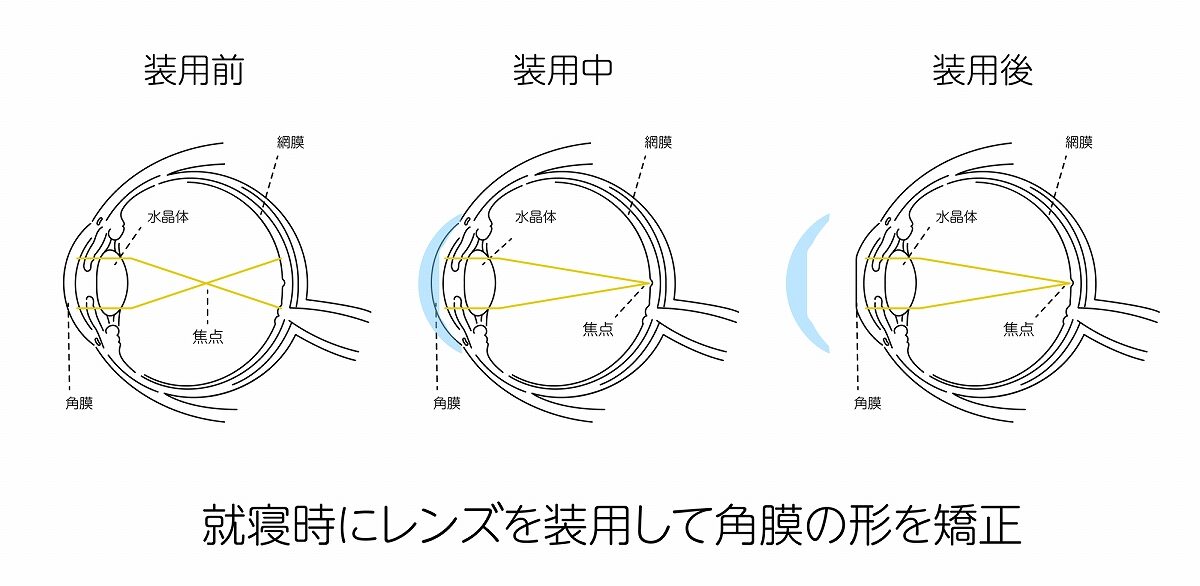 オルソケラトロジーとは